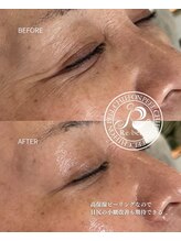 SDルーム/リベルシフォンピーリング