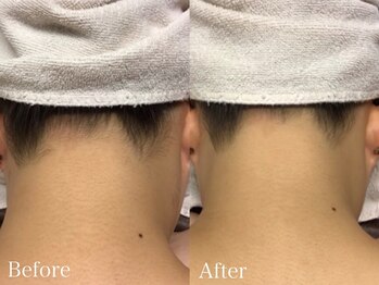 ラウレア 松山店(LAULEA)/襟足脱毛