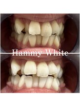 ハミーホワイト(Hammy White)/しっかり効果がでます！