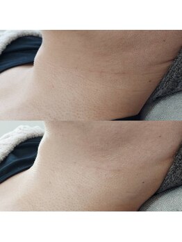 ヴェルシック(Belchic)/首のシワ改善もお顔と一緒に可能