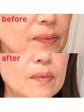 アンバーアイズ 池田本店(Amber eyes)/お肌のハリが変わる！！