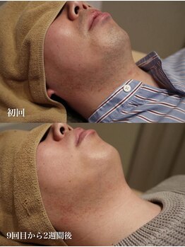 ベビースキン(baby skin)/髭脱毛