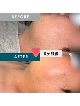 モモナ(Momona)/佐世保/脱毛/髭脱毛/全身脱毛