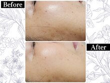 ポーベルポー(Peau Belle poe)/無添加国産ハーブピーリング