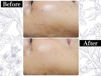 ポーベルポー(Peau Belle poe)/無添加国産ハーブピーリング