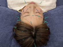 ビースタイル(B-style)/【美容鍼灸】電気美容鍼灸施術