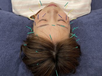 ビースタイル(B-style)/【美容鍼灸】電気美容鍼灸施術