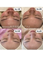 エイティ(Atey)/肌質改善プログラム