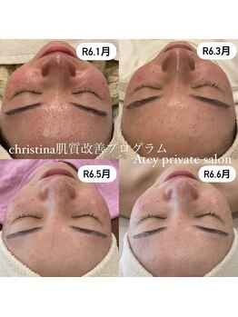 エイティ(Atey)/肌質改善プログラム