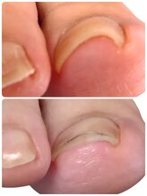 フットケアサロン ラビフット(Rabbi foot)/巻き爪片巻