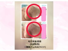 クローバー(clover)/汚れごっそり！本気毛穴洗浄