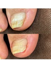 リリ(lili)/巻き爪矯正3回目（右親指）