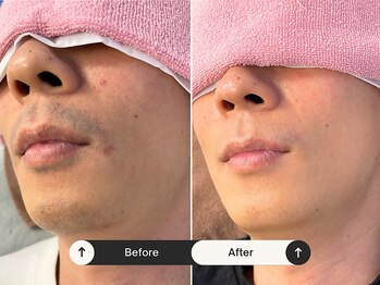 パッソ(Passo)/脱毛男子急増中/男性施術者