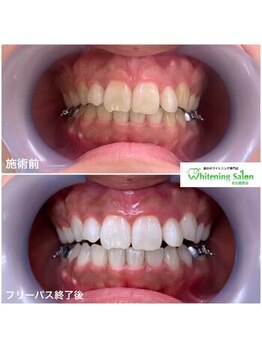 ホワイトニングサロン 名古屋駅店/【ホワイトニング施術例】