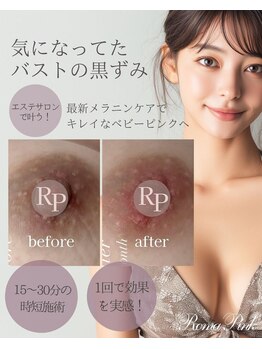 ルミアリュクス(LUMIA LUXE)の写真/仙台希少☆韓国で大人気シミケアで透明感を。ローマピンク黒ずみケアでデリケートゾーン乳輪など美肌作りを