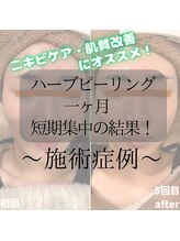 ビアル(VIALU)/ハーブピーリング♪肌質改善