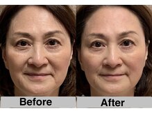 あおき鍼灸整骨院/小顔美容鍼　施術1回効果