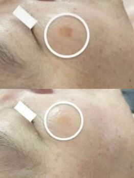 ラエッセ 恵比寿(LAESSE)/毛穴・美白専門店 LAESSE 恵比寿