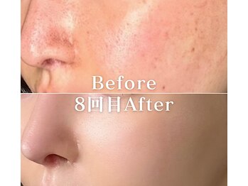 ミニョスキンラボ/W幹細胞ハーブピーリング8回