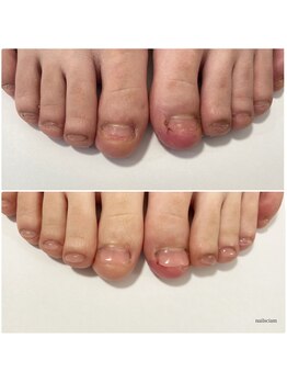 ネイルズシアム/足の深爪矯正もお任せください