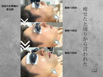 ル シャ/光フェイシャル/リフトアップ