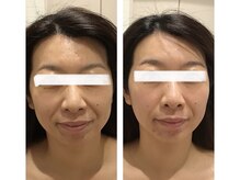 エヌ セレクション(N_selection)/オリジナル美筋小顔マッサージ!!