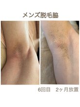 ハロ(Halo)/メンズワキ脱毛