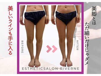 リヴェーヌ 富山店の写真/【お尻まで小さく♪】長年のガチむち太もも&ふくらはぎに徹底アプローチし脚の歪みを根本改善!丁寧な施術◎