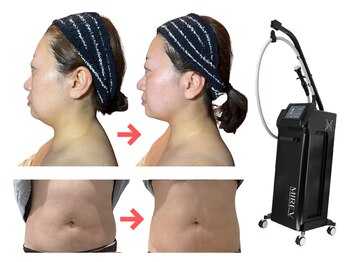 レディラック 大阪梅田本店(Lady Luck)の写真/韓国で大人気のオンダマイクロ波リフトで、脂肪撃退！小顔とたるみケアで理想の自分へ★