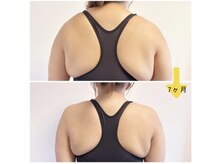 ポノフィット(PONO FIT.)/症例／首、肩、背中