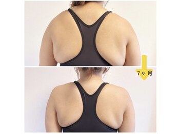 ポノフィット(PONO FIT.)/症例／首、肩、背中