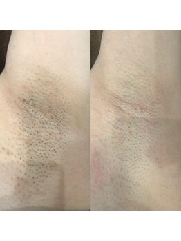 ナンバーサーティーン(NUM13ER)の写真/全身脱毛が都度払いOK!経験豊富なスタッフによる丁寧な施術で、脱毛初心者さんも自信が持てるお肌へ!