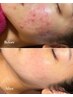【繰り返すニキビ改善を本気で目指したい方】ハーブピーリングで最短つるん肌