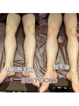 ステイゴールド 新百合ヶ丘(STAY GOLD)/脱毛後は、しっかり保湿を！