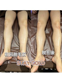 ステイゴールド 新百合ヶ丘(STAY GOLD)/脱毛後は、しっかり保湿を!