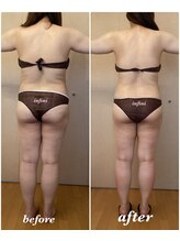 アンフィニ(infini)/全身短期集中コース（4ヶ月9回）