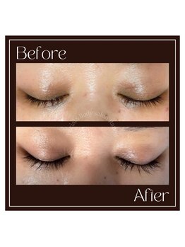 ラノン(Ranon)/エグータムBefore／After(1)