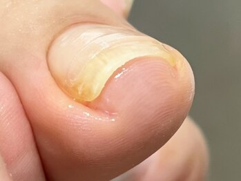 爪屋の写真/繰り返す「巻き爪」「変形爪」「肥厚爪」「爪の変色」など、悩める爪のトラブルを解消！専門店の技術◎