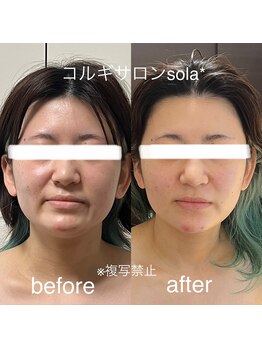 ソラ(sola*)/顎スッキリシャープに小顔