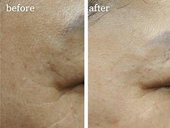 メルシア(merucia)/小じわ、ハリ、潤い