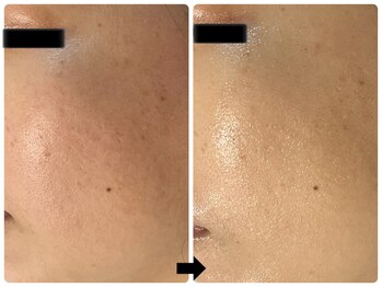 エフェクト 塚口店(effect)/Before After 30代/1回目