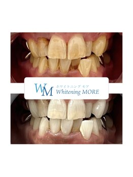 ホワイトニング モア(Whitening MORE)/ビフォーアフター