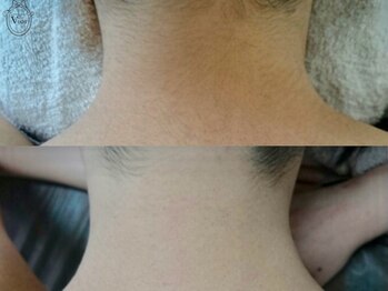 ヴィオール 名古屋栄店(VIOR)/レディース脱毛】 うなじ