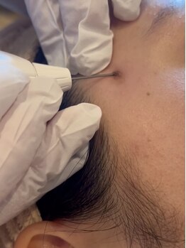 ミューズ(MUSE)の写真/【徹底的に肌質改善】シミ改善特化最新マシーン導入★全ての肌悩みはこの一台で完結！！エステ超えの効果！