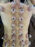 すっきりしたいあなたへ背中カッピング・スライドカッピング【施術時間40分】