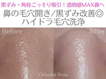 オリエンタルローザ 表参道(Oriental Rosa)/鼻の毛穴開きハイドラ毛穴洗浄◎