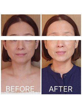 カノン(KANON)/グリーンピール施術当日