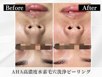 ポーベルポー(Peau Belle poe)/AHA高濃度水素毛穴ピーリング