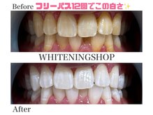 ホワイトニングショップ 名古屋店/【ビフォーアフター】フリーパス