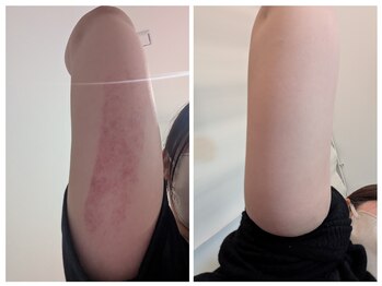 ひぺりかむ/DualCryo360【施術後~その後】